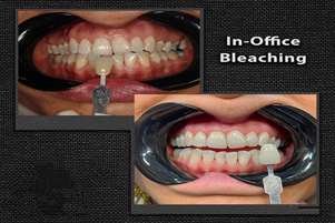 بیلیچینگ دندان؛ زیبایی لبخند با رعایت اصول علمی 